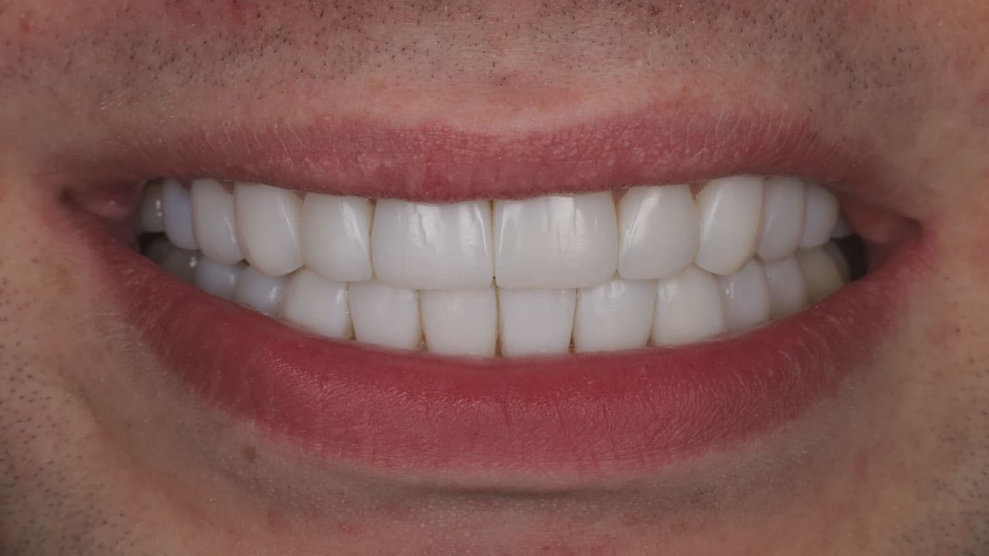 David after treatment